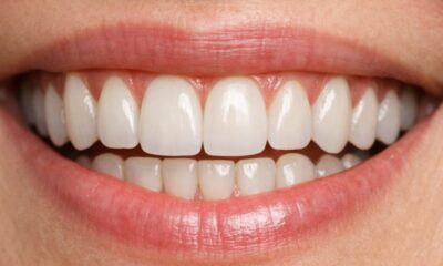 Dental implants