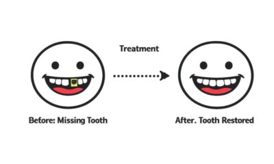 Missing Teeth