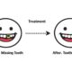 Missing Teeth